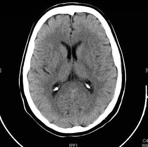 Image of Neurodegenerative Disease