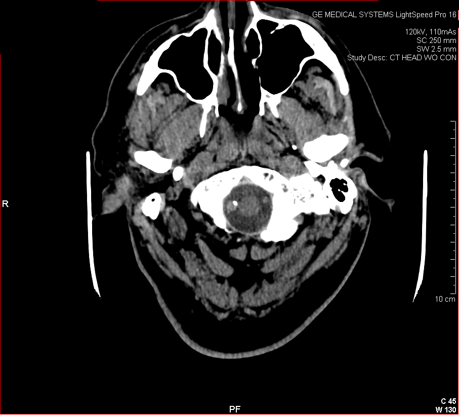 Image of vertebral artery dissection